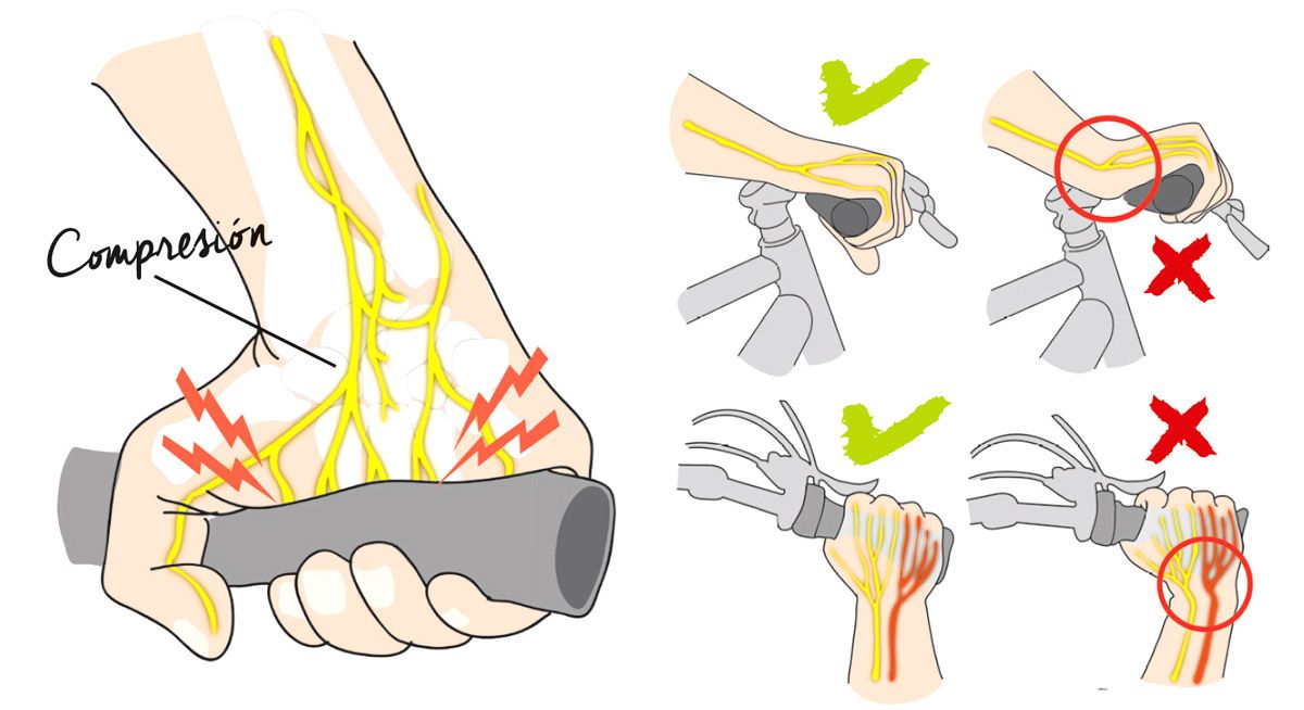 El fastidioso y recurrente problema del adormecimiento de manos detalle 2