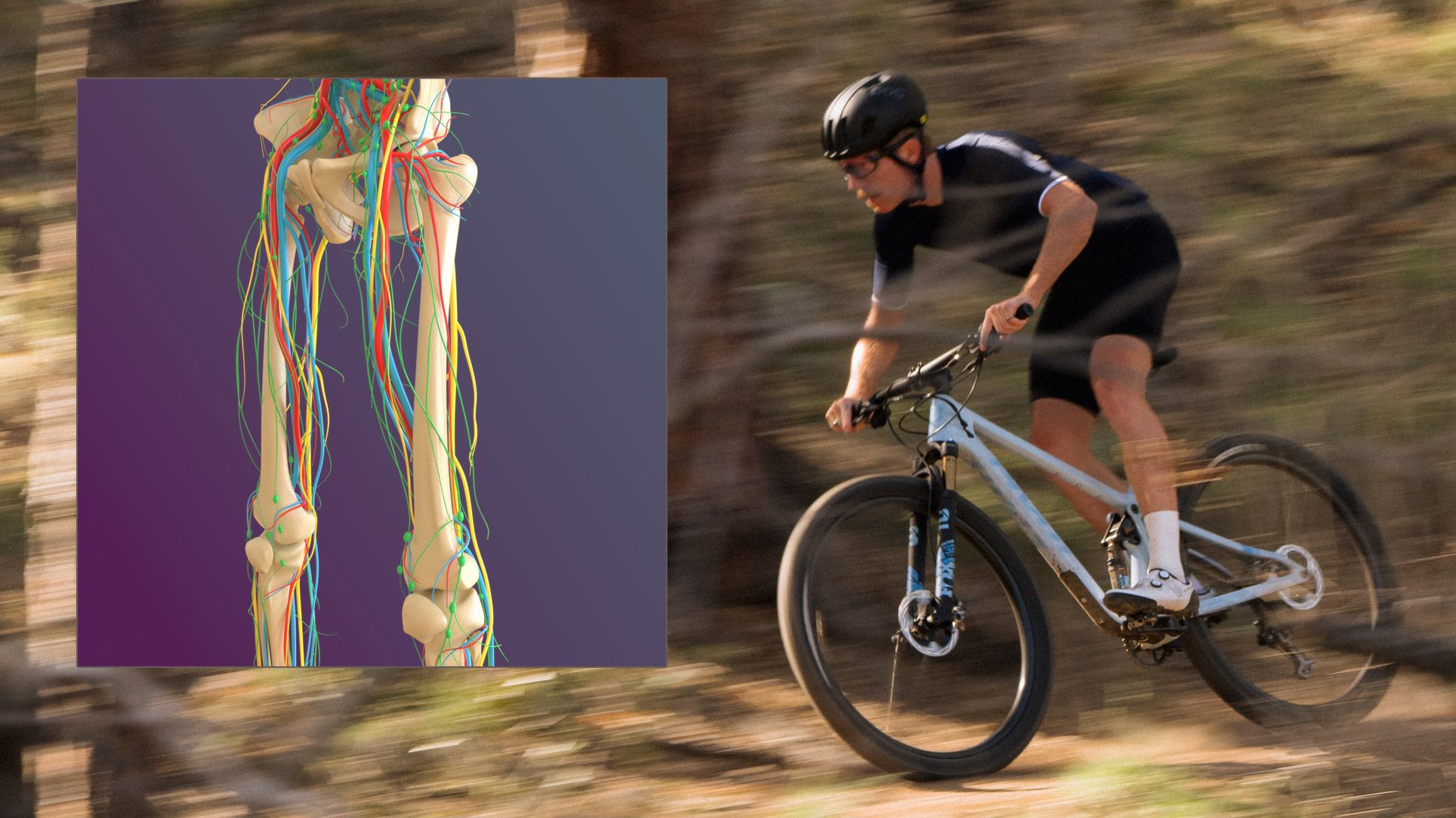 Endofibrosis, una lesión no tan rara en ciclistas