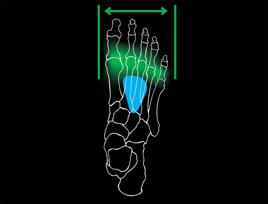 metatarsal button